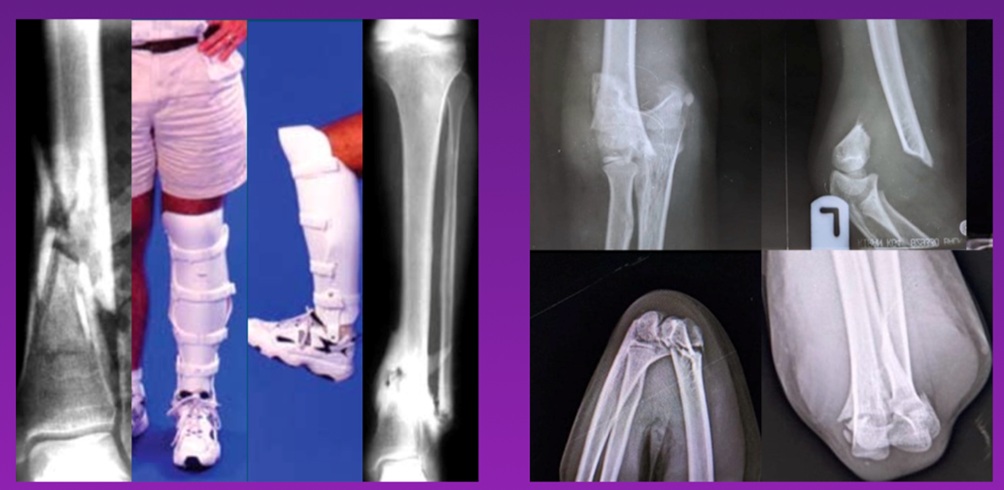 biological-fracture-management-course